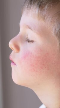 Child side view showing skin redness and irritation, medical concept of allergy and dermatitis, pediatric diagnosis including parvovirus b19 and viral infection signs on face. Erythema infectiosum 