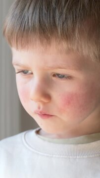 Boy with red cheeks and rash symptoms looking down, allergy and dermatitis concept in pediatric healthcare, viral infection and skin irritation visible for medical diagnosis use. 
