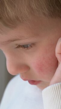 Boy face macro view shows infection related rash. Infection symptoms tied to erythema infectiosum and parvovirus b19 affecting child skin and dermatology analysis. Child closeup scratching cheek