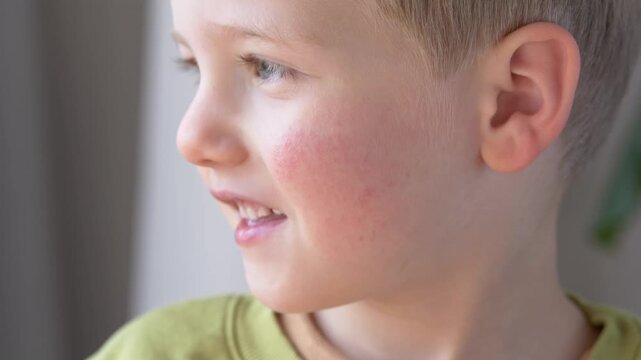 Smiling child with red cheeks and visible rash showing allergy, atopic dermatitis, parvovirus B19 or erythema infectiosum. Pediatric dermatology concept with treatment. Boy with irritated skin. 