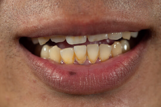 Yellow teeth, gums, and tartar.