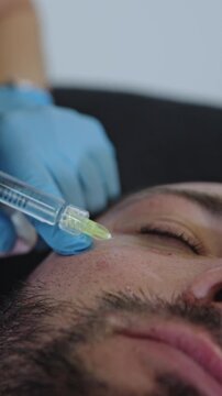 This close-up view captures a medical doctor specialized in aesthetic medicine, performing a precise intradermal injection of polynucleotides on a male patient.