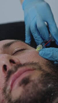 This close-up view captures a medical doctor specialized in aesthetic medicine, performing a precise intradermal injection of polynucleotides on a male patient.