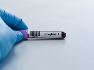 Obraz premium Blood sample tube for hemoglobin E test analysis.