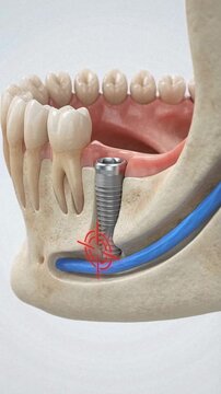 Dental implant placement near nerve canal in jawbone, highlighting potential risk in a medical background animation
