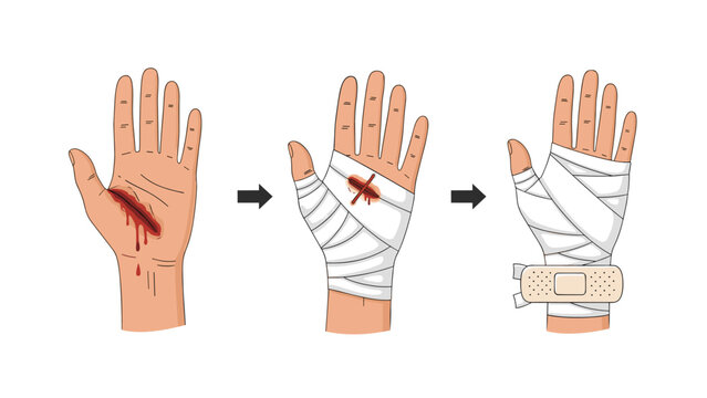 Medical infographic showing a sequence of steps to treat a bleeding hand wound with a white bandage and a finishing medical adhesive plaster.