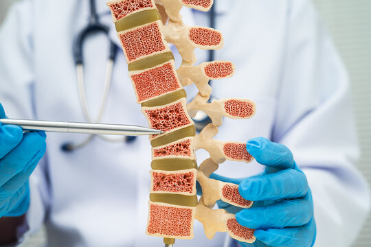 Doctor holding osteoporosis in back bone model.