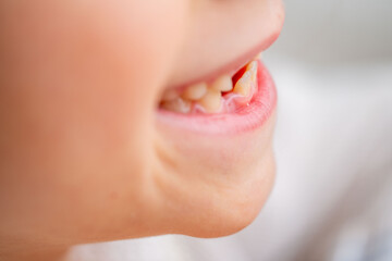 Fototapeta premium happy positive caucasian funny toothless 6-year-old girl, child baby tooth, smiling childhood moment waiting for toothfairy, growing up, cute Toothless smile expression, innocence and joy childhood