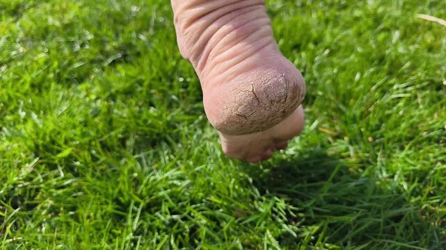 Authentic real life footage of a bare elderly foot in green grass showing a dry severely cracked heel, outdoor setting, dermatology healthcare and medical foot care problem, no ai
