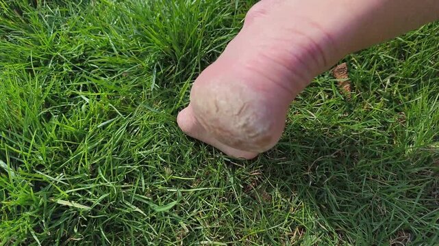 Authentic real life footage of a bare elderly foot in green grass showing a dry severely cracked heel, outdoor setting, dermatology healthcare and medical foot care problem, no ai