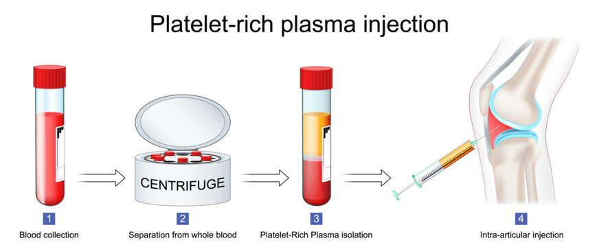 Platelet-rich plasma procedure. Blood сollection, PRP separation from whole blood and Intra-articular injection.