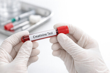 Obraz premium Scientist holding blood sample tube for creatinine test. Healthcare professional performing renal function check. Clinical laboratory diagnostic procedure for kidney disease analysis.