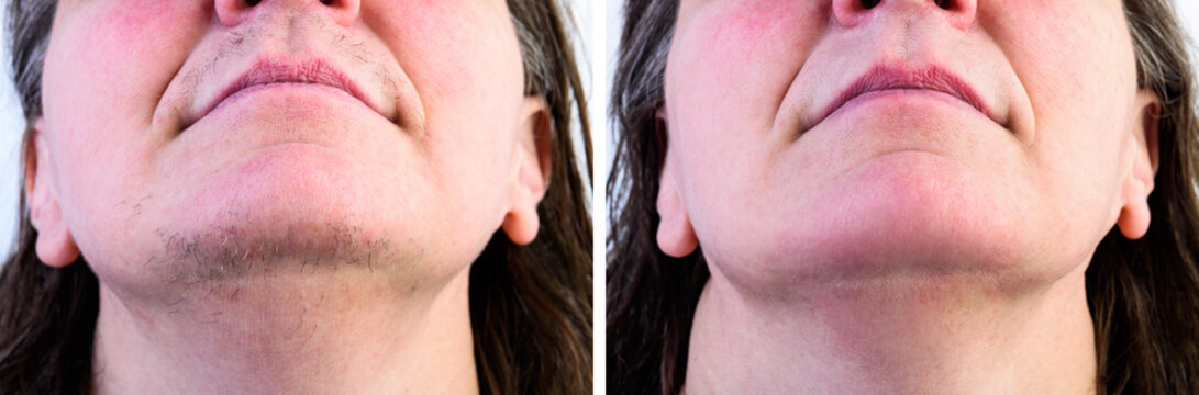 Woman's face with moustache and hairs on chin. Before and after hair removal and epilation.