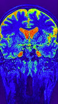 Vibrant Coronal View of Human Brain Scan with Heat Map Colors, Medical AI and Neuroscience Technology Background, Wellness and Mental Health Concept for Poster and Banner. High contrast colored MRI sc