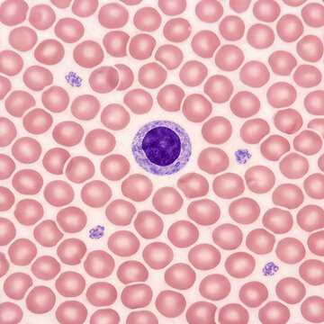 Lymphocyte in Peripheral Blood Smear