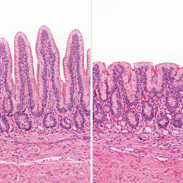Normal Villi and Celiac Disease Histology Comparison