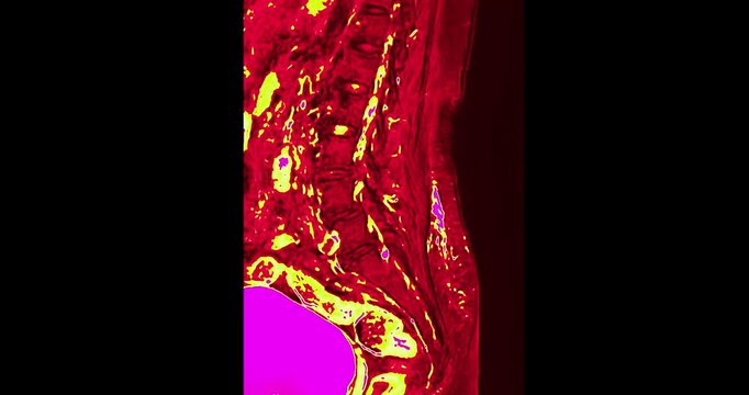 Medical video footage of an MRI lumbar spine scan revealing lumbar spondylosis and a herniated disc at the L3-L4 level. Perfect for healthcare, neurology, and orthopedic diagnostic concepts.