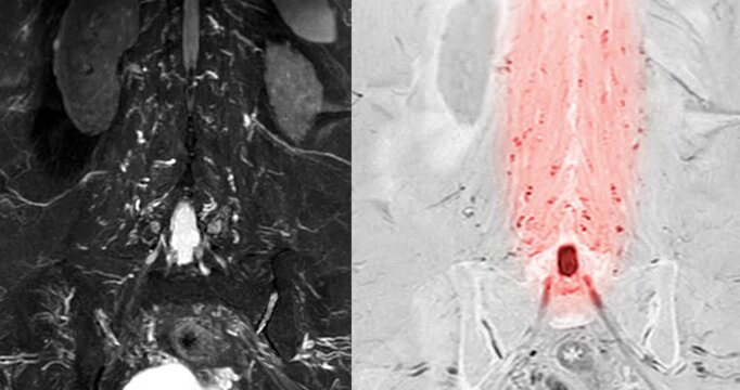 Medical video footage of an MRI lumbar spine scan revealing lumbar spondylosis and a herniated disc at the L3-L4 level. Perfect for healthcare, neurology, and orthopedic diagnostic concepts.