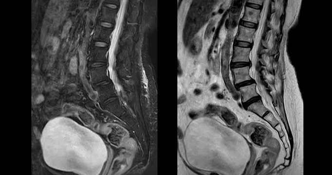 Medical video footage of an MRI lumbar spine scan revealing lumbar spondylosis and a herniated disc at the L3-L4 level. Perfect for healthcare, neurology, and orthopedic diagnostic concepts.