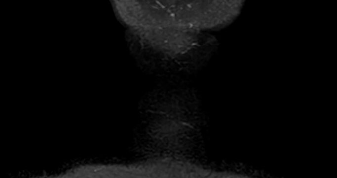 Magnetic resonance imaging (MRI) of a healthy human cervical spine and brachial plexus. Normal medical scan showing no spinal canal stenosis or nerve compression. Ideal for healthcare concepts.