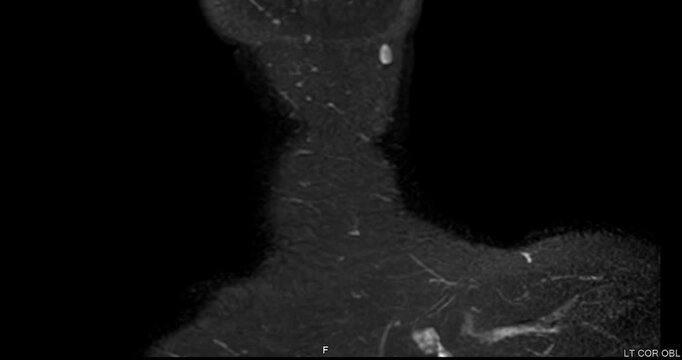 Magnetic resonance imaging (MRI) of a healthy human cervical spine and brachial plexus. Normal medical scan showing no spinal canal stenosis or nerve compression. Ideal for healthcare concepts.