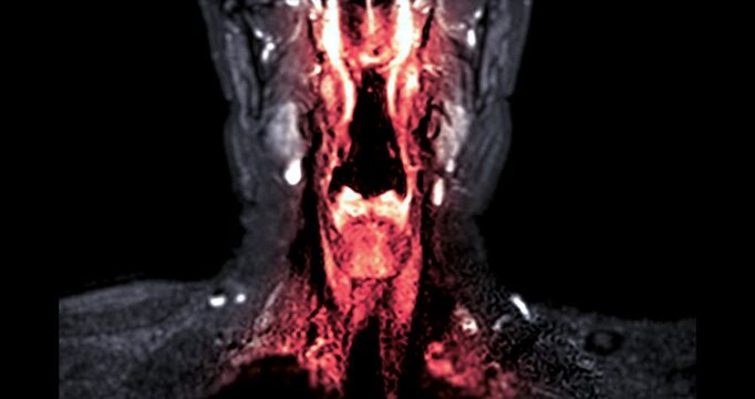 Magnetic resonance imaging (MRI) of a healthy human cervical spine and brachial plexus. Normal medical scan showing no spinal canal stenosis or nerve compression. Ideal for healthcare concepts.