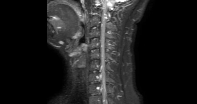 Magnetic resonance imaging (MRI) of a healthy human cervical spine and brachial plexus. Normal medical scan showing no spinal canal stenosis or nerve compression. Ideal for healthcare concepts.