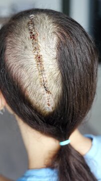 Close up of fresh surgical scar with staples on shaved head one week after craniotomy for brain tumor removal. Early postoperative healing and recovery concept.