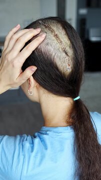 Back view of woman with surgical scar after brain tumor removal surgery. Craniotomy and meningioma treatment concept.