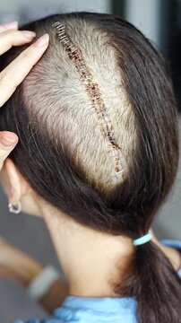 Close up of fresh surgical scar with staples on shaved head one week after craniotomy for brain tumor removal. Early postoperative healing and recovery concept.