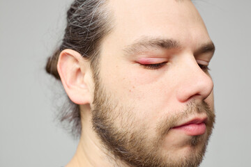 Obraz premium Swollen red eyelid close-up, eye inflammation or stye, medical condition