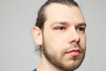 Obraz premium Swollen red eyelid close-up, eye inflammation or stye, medical condition