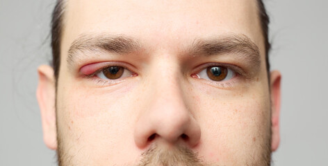 Naklejka premium Swollen red eyelid close-up, eye inflammation or stye, medical condition