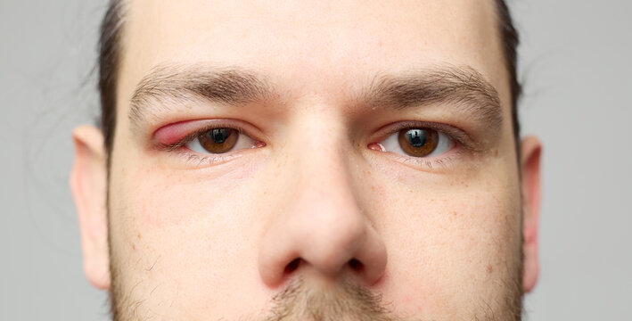 Swollen red eyelid close-up, eye inflammation or stye, medical condition