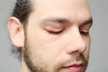 Fototapeta premium Swollen red eyelid close-up, eye inflammation or stye, medical condition