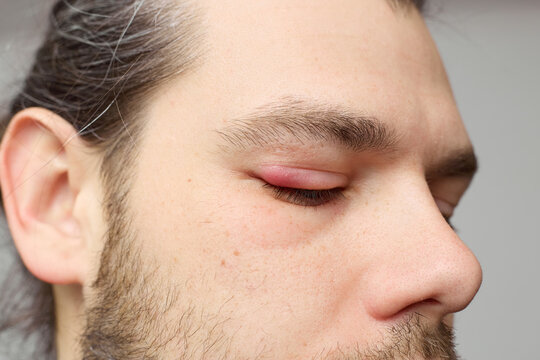 Swollen red eyelid close-up, eye inflammation or stye, medical condition