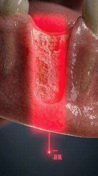 Advanced Dental Surgery Animation Showing Jaw Bone Infection and Laser Treatment for Oral Health
