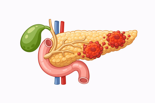 Illustration of the pancreas and gallbladder showing cancerous tumors growing on the organ