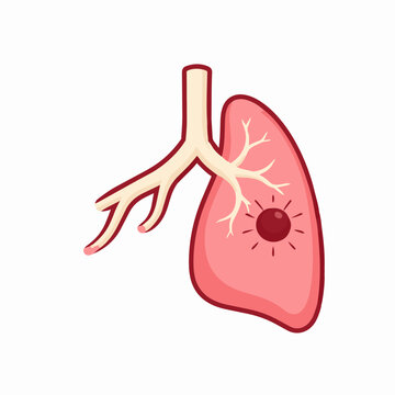 Illustration of a diseased lung with a dark red spot representing a tumor or infection