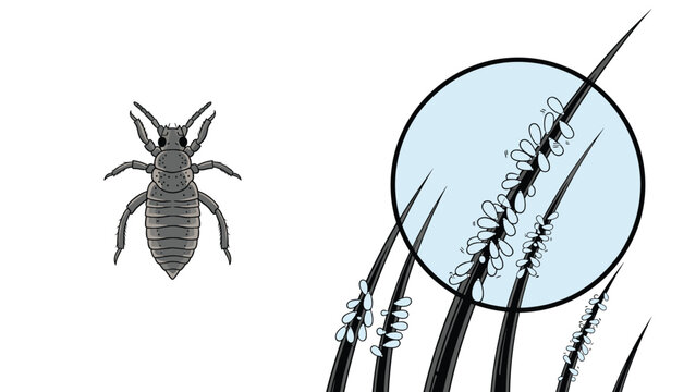 Head louse insect illustration beside a magnified view of human hair strands heavily infested with nits and lice eggs.