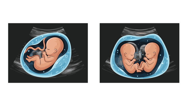 Medical diagram comparing a single fetus and twins during an ultrasound examination to show developmental differences.