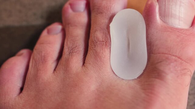 Close-up of silicone toe separators, widely used in physiotherapy and podiatry as part of conservative treatment methods. High quality 4k footage