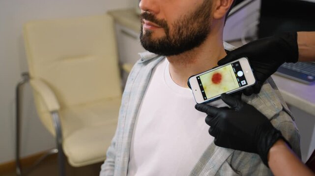 Dermatologist examining patient's mole with smartphone dermatoscope