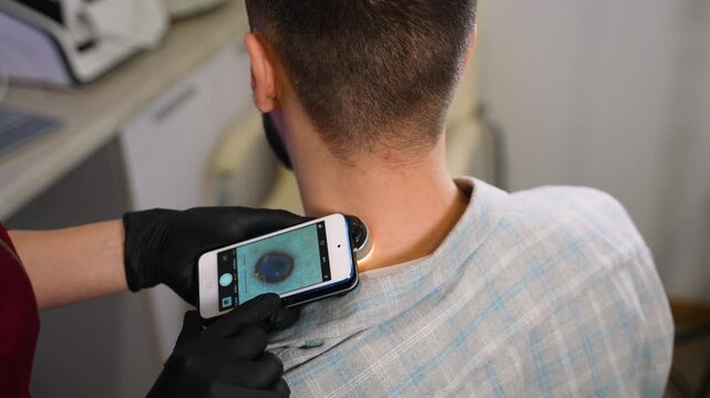 Dermatologist using smartphone dermatoscope for skin cancer check