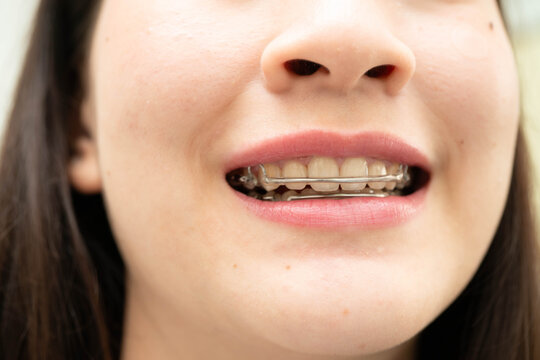 Asian woman wearing Hawley retainer removable orthodontic appliance maintain position of teeth.