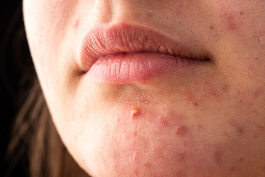 Close up acne on skin. Inflamed skin bumps acne macro. Macro shot of skin irritation with acne. Detailed skin with acne.