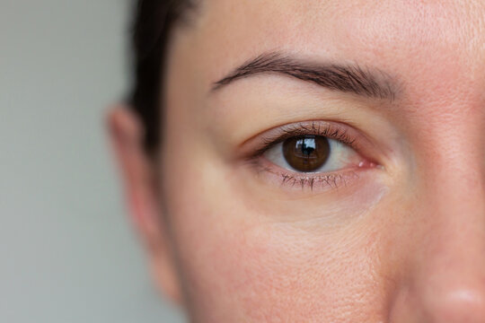 Close-up shot of young woman with a swollen face and eyes, showing signs of fluid retention from poor sleep or health issues.