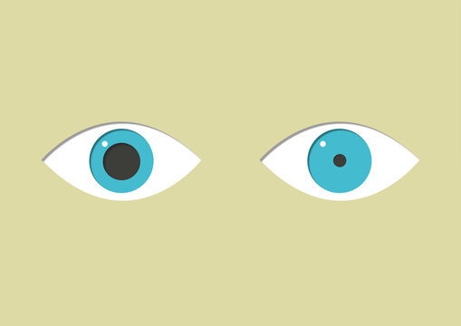 Anisocoria, illustration