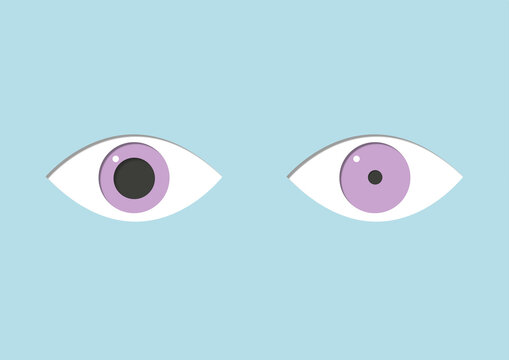 Anisocoria, illustration