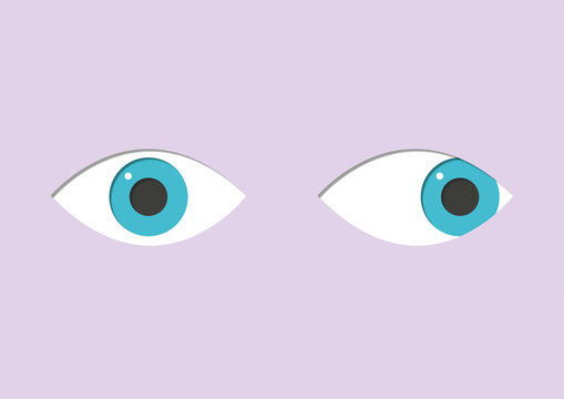 Strabismus, illustration